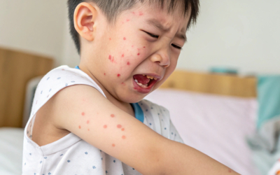 Ветряночная вечеринка? Врач против